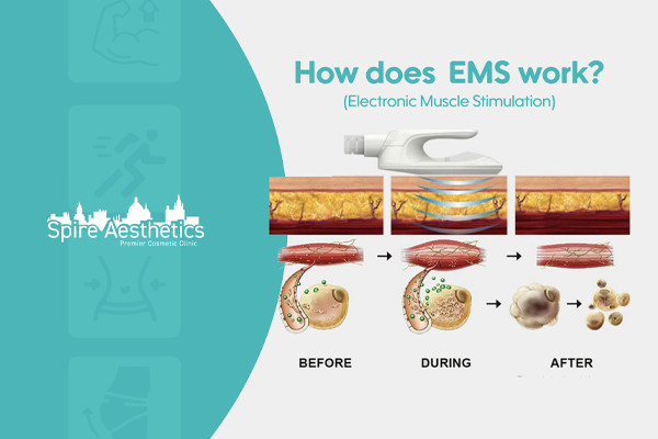 EMS treatment for post pregnancy weight loss treatment Lincolnshire