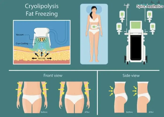 Fat freezing treatment Lincolnshire benefits for competitions to remove stubborn fat deposits.