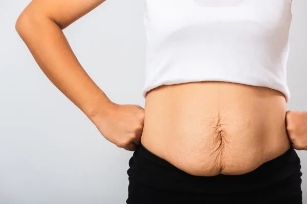 Image of a woman's stomach after weight loss with sagging skin following a gastric band Lincolnshire