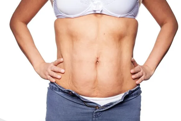 sagging skin on woman's stomach after weight loss injections Lincolnshire