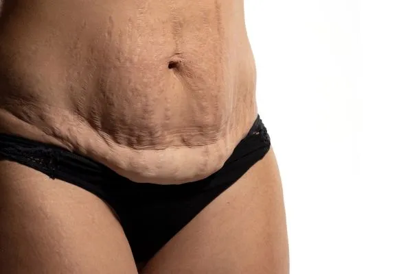 Image of womans stomach after weight loss injections Lincolnshire showing saggy skin