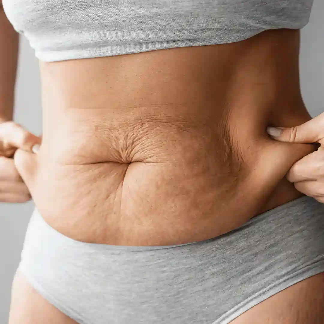 Is It Normal to Have Loose Skin After Pregnancy Lincolnshire?