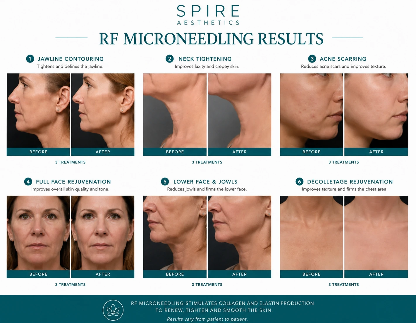 RF Microneedling Skin tightening Lincolnshire results