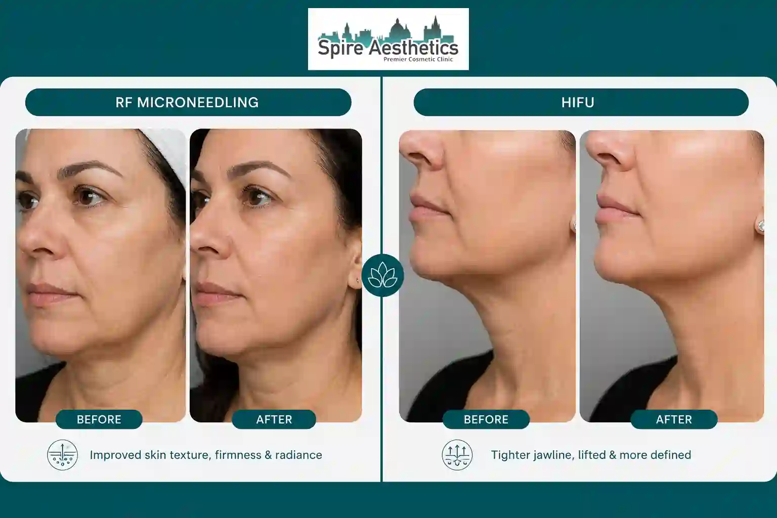 Can RF Microneedling and HIFU Be Combined Lincolnshire?