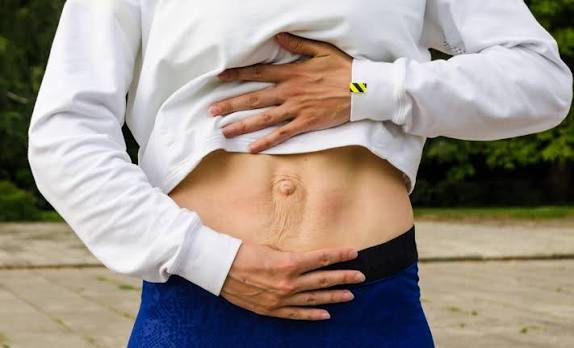 When Could Diastasis Recti Be the Missing Piece of the Puzzle Lincolnshire?