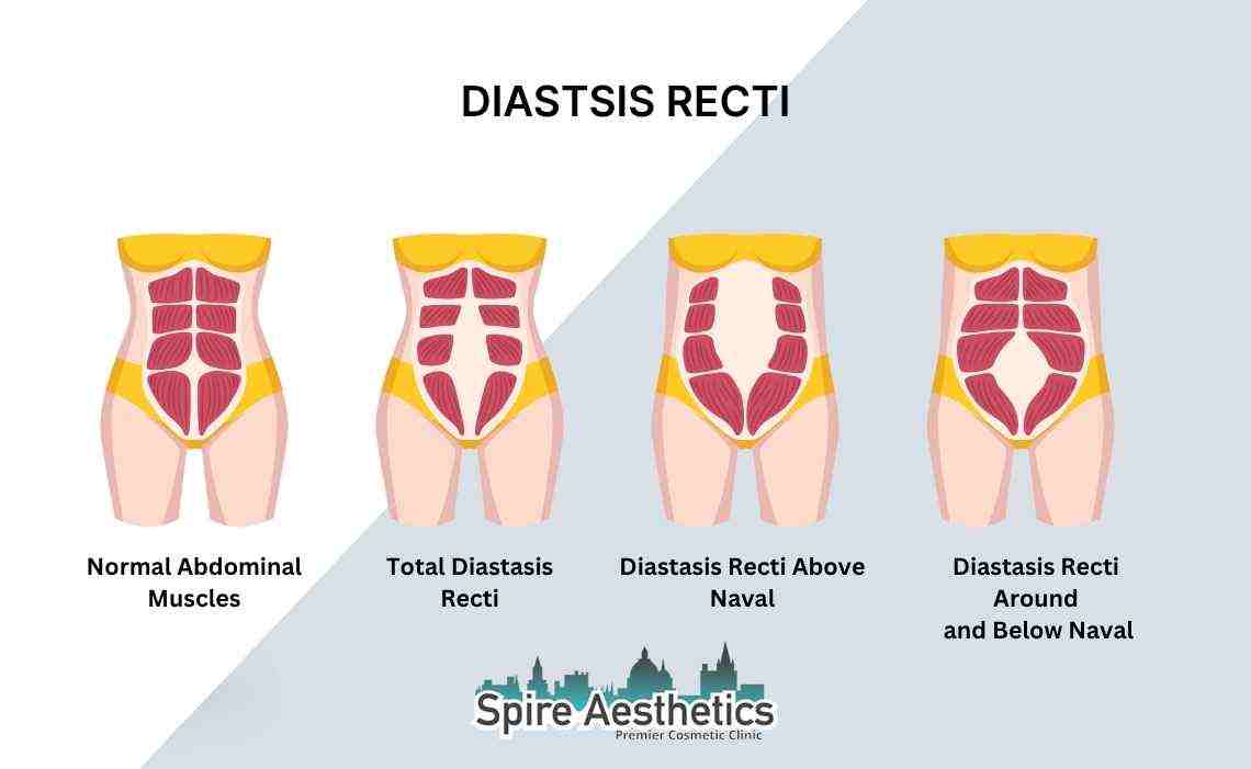 Is Non-Surgical Diastasis Recti Treatment Right for You? Common Concerns Answered Lincolnshire